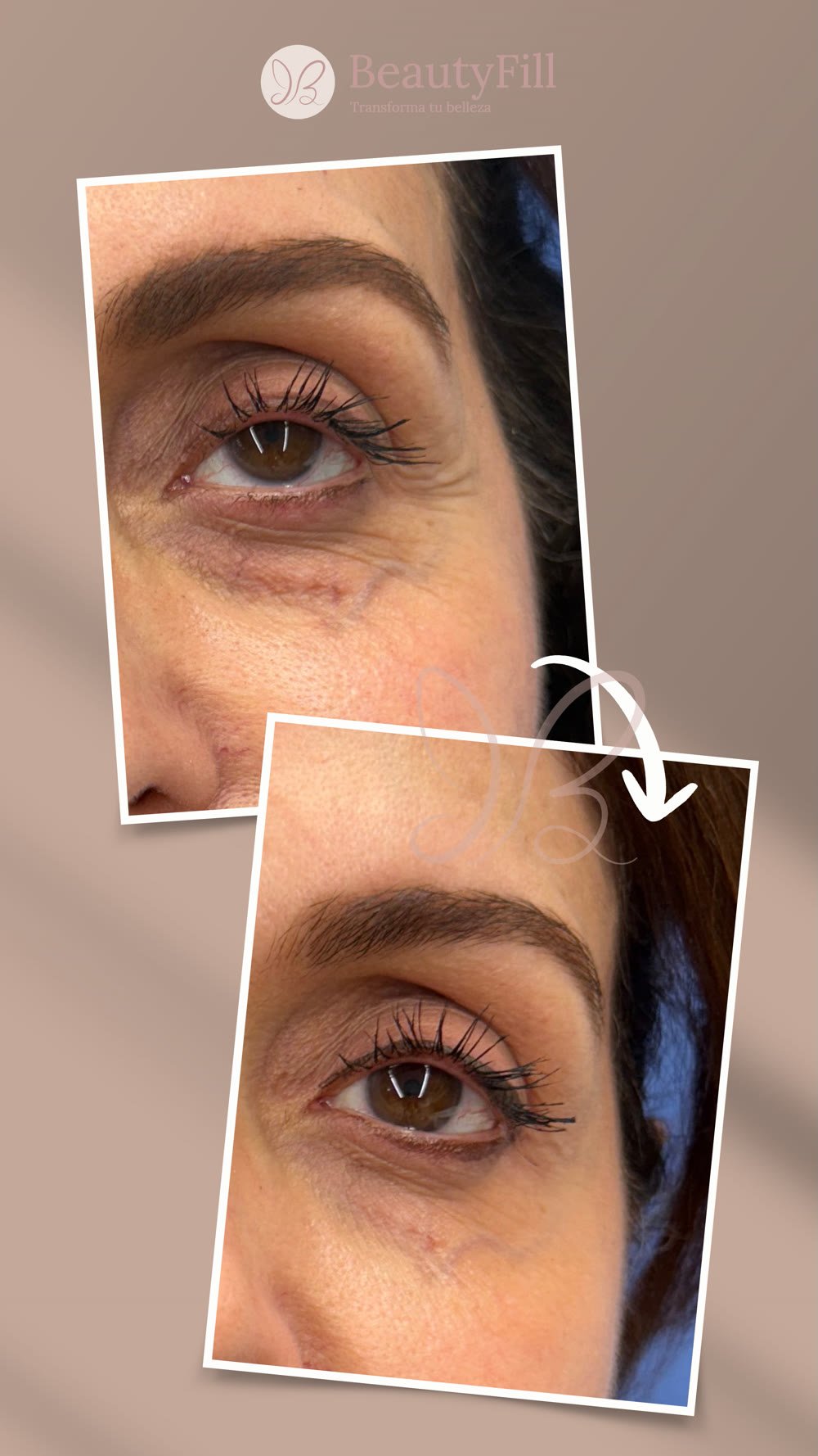 Antes y después contorno de ojos