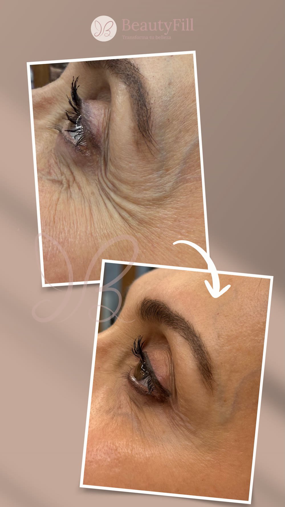 Antes y después contorno de ojos