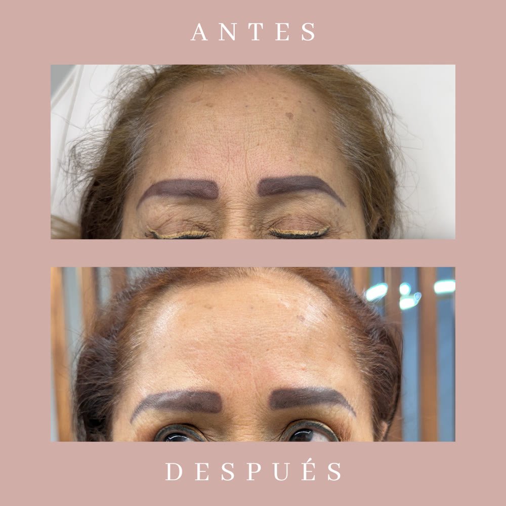 Antes y después frente y cejas