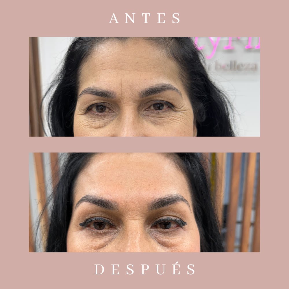Antes y después contorno de ojos