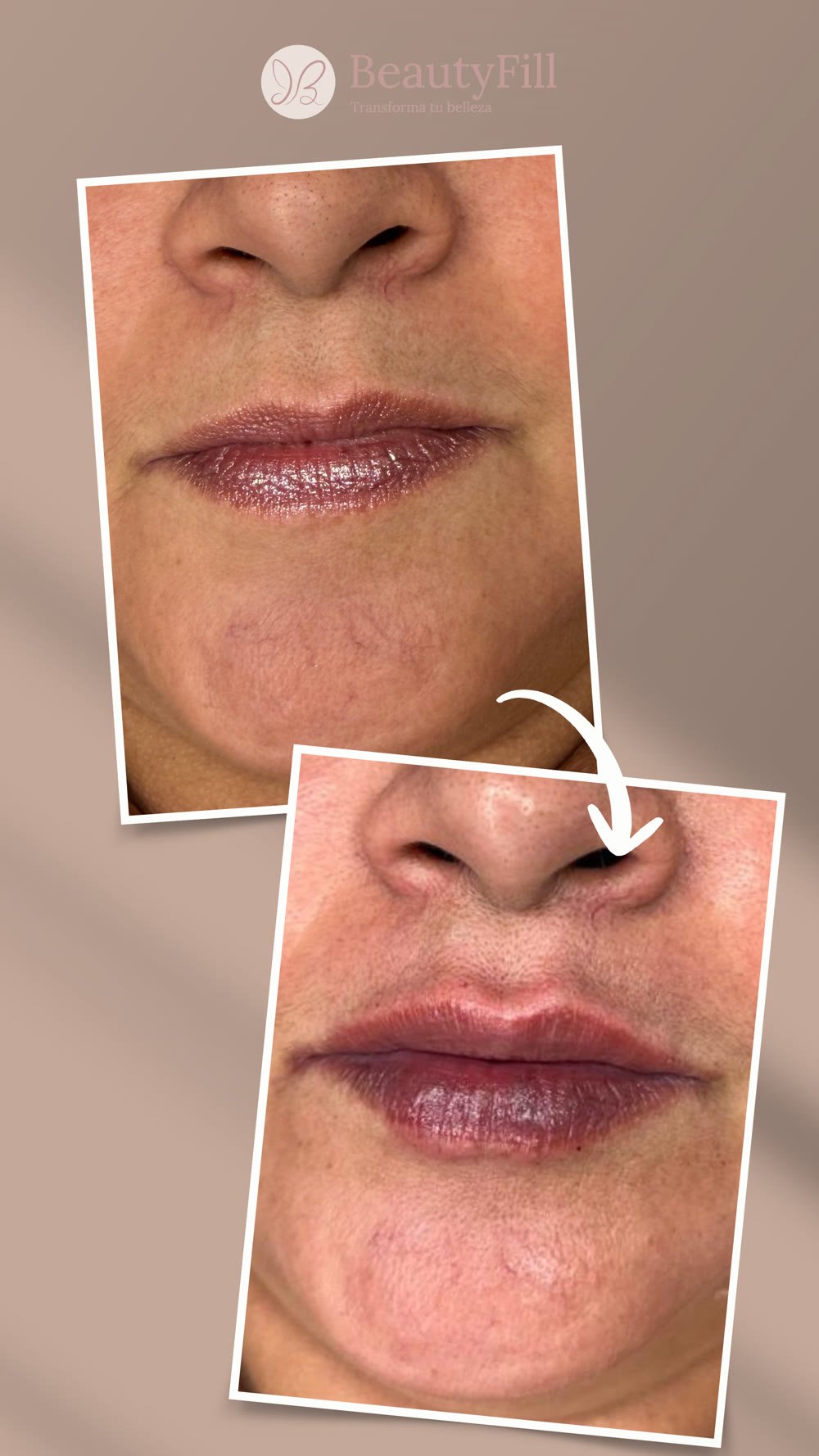 Antes y después labios y nariz