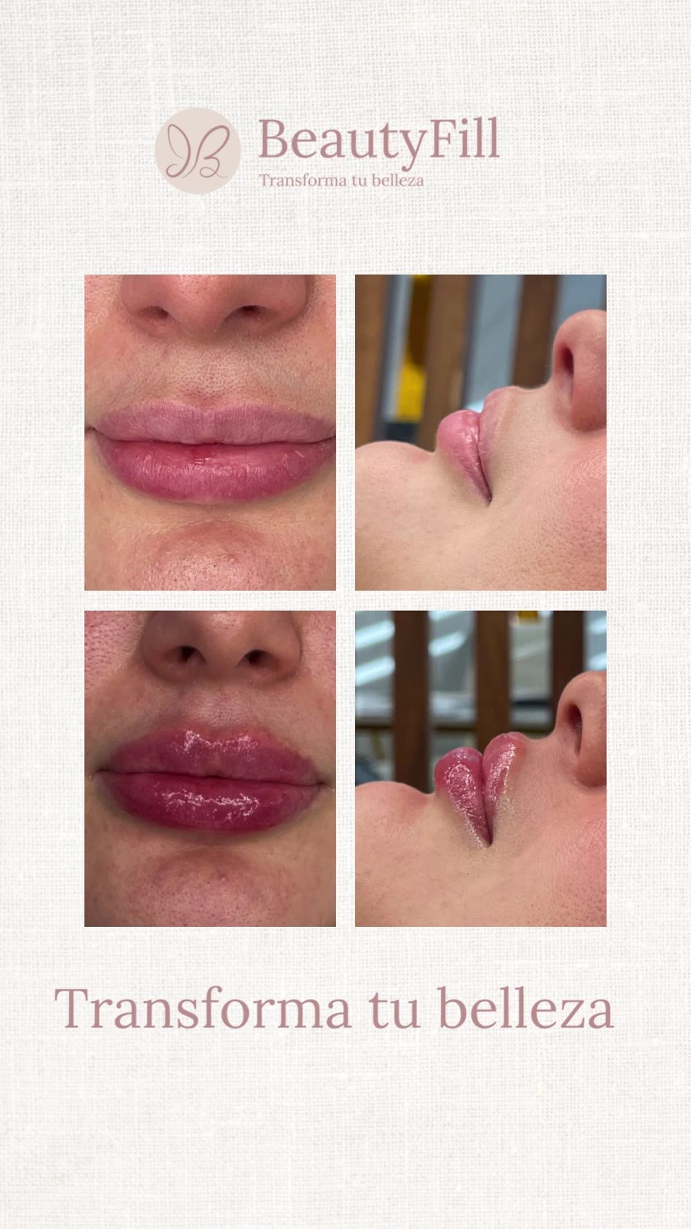 Antes y después tratamiento facial